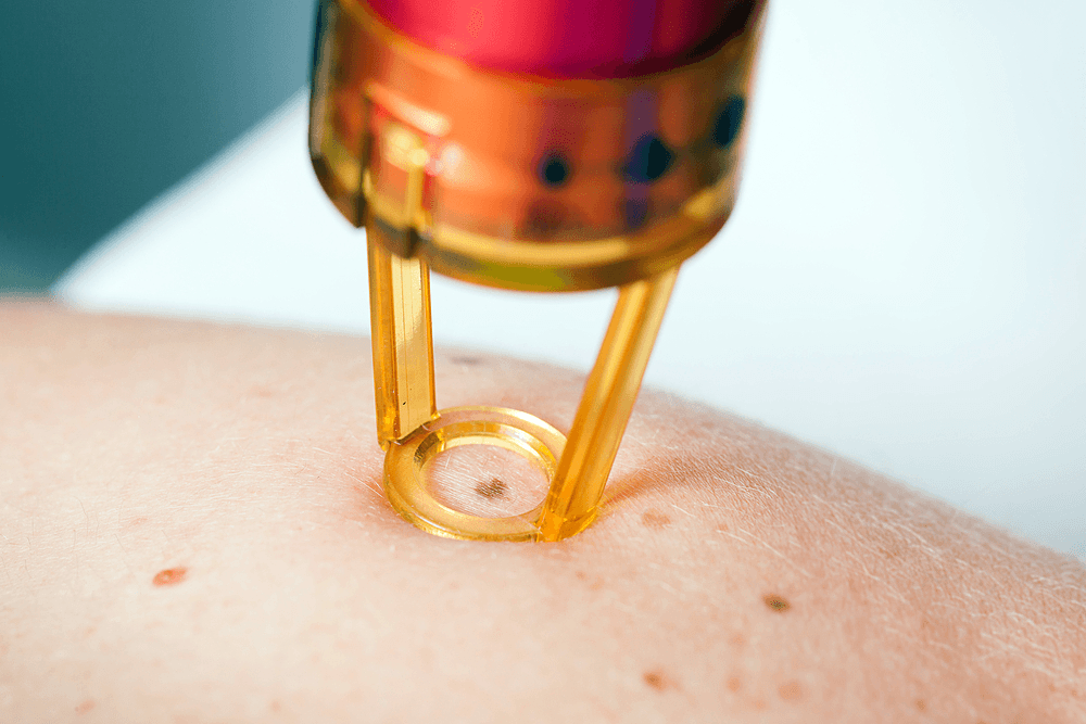 Laser Birthmark Removal: A Comprehensive Guide