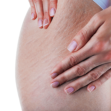 Cellulite and stretch marks are the most complained about effects of aging by women.